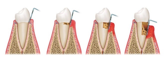 periodoncia Costa Rica