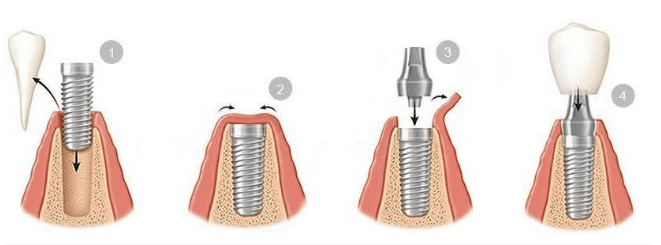 Implantes Dentales Costa Rica