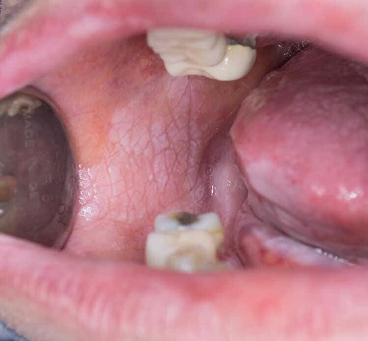 biopsia-boca-costa-rica-1