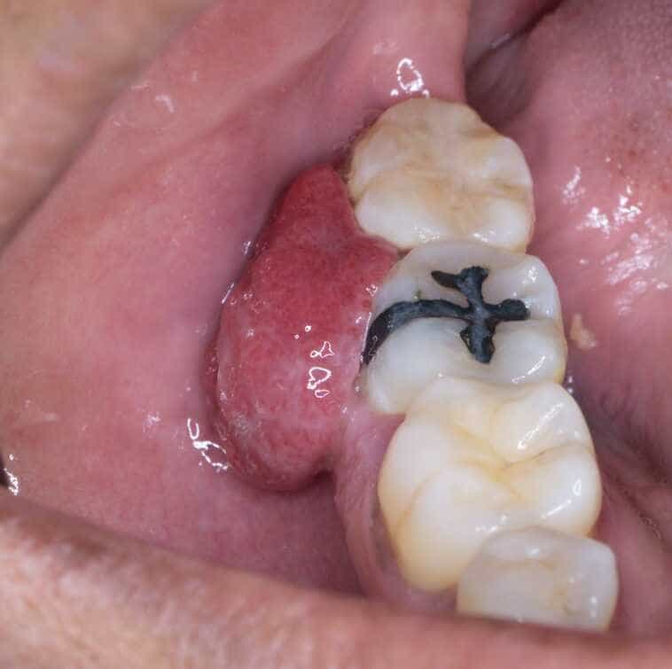 biopsia-boca-costa-rica-4