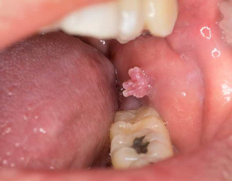 biopsia-boca-costa-rica-5