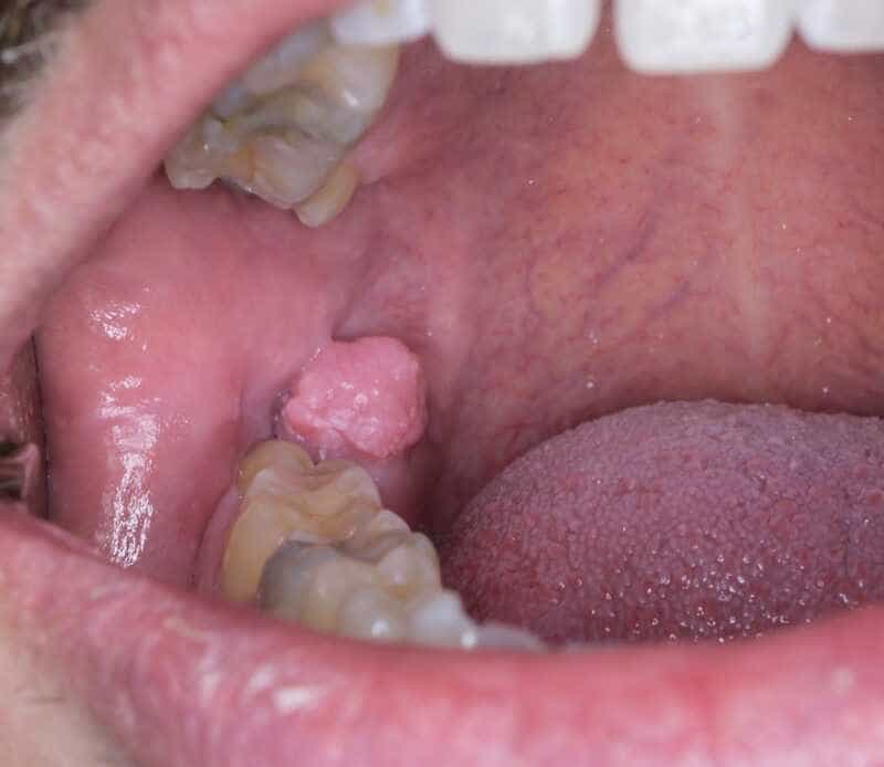 biopsia-boca-costa-rica-6