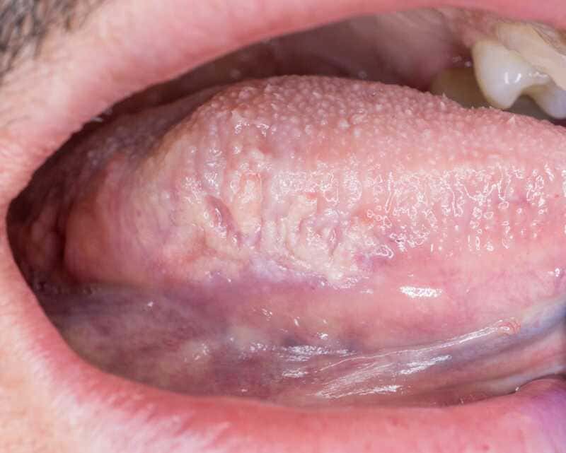 biopsia-boca-costa-rica-9
